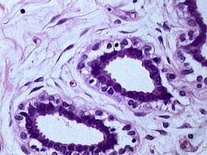 Breast cancer. Image made by Itayba Breast cancer. Image made by Itayba