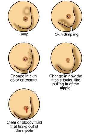 Early signs of breast cancer.